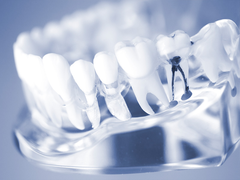 診療案内_根管治療