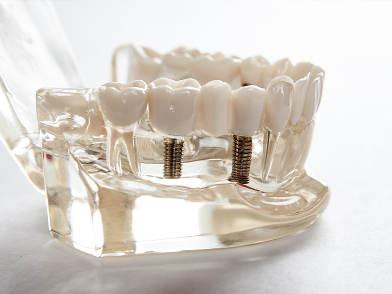 診療案内_インプラント